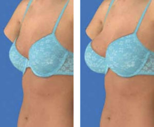 3D of breast enhancement before and after
