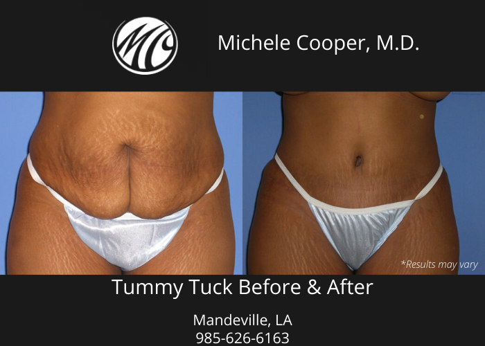 Tummy Tuck Surgery performed by Dr. Michele Cooper in Mandeville, LA