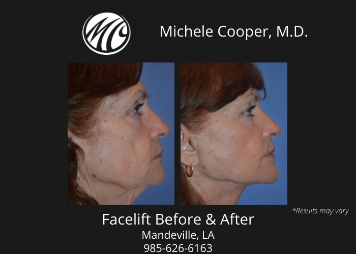 Before and after image showing the results of a facelift surgery performed in Mandeville, LA.