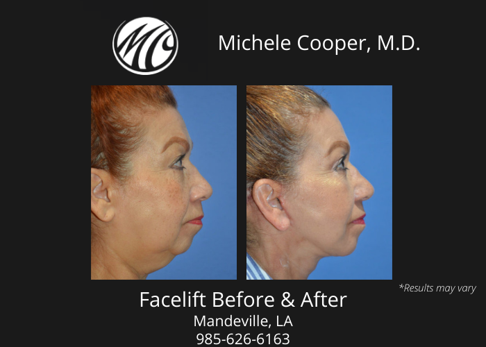 Before and after image showing the results of a facelift surgery performed in Mandeville, LA.