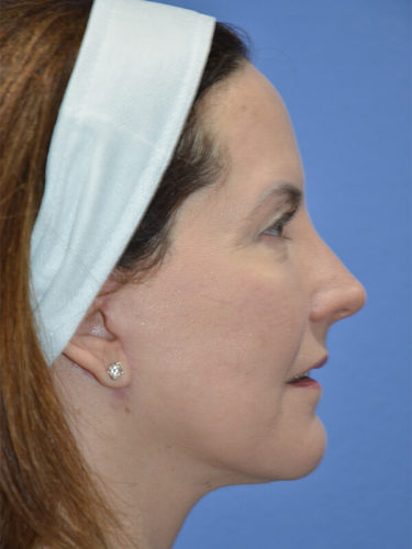 After Image